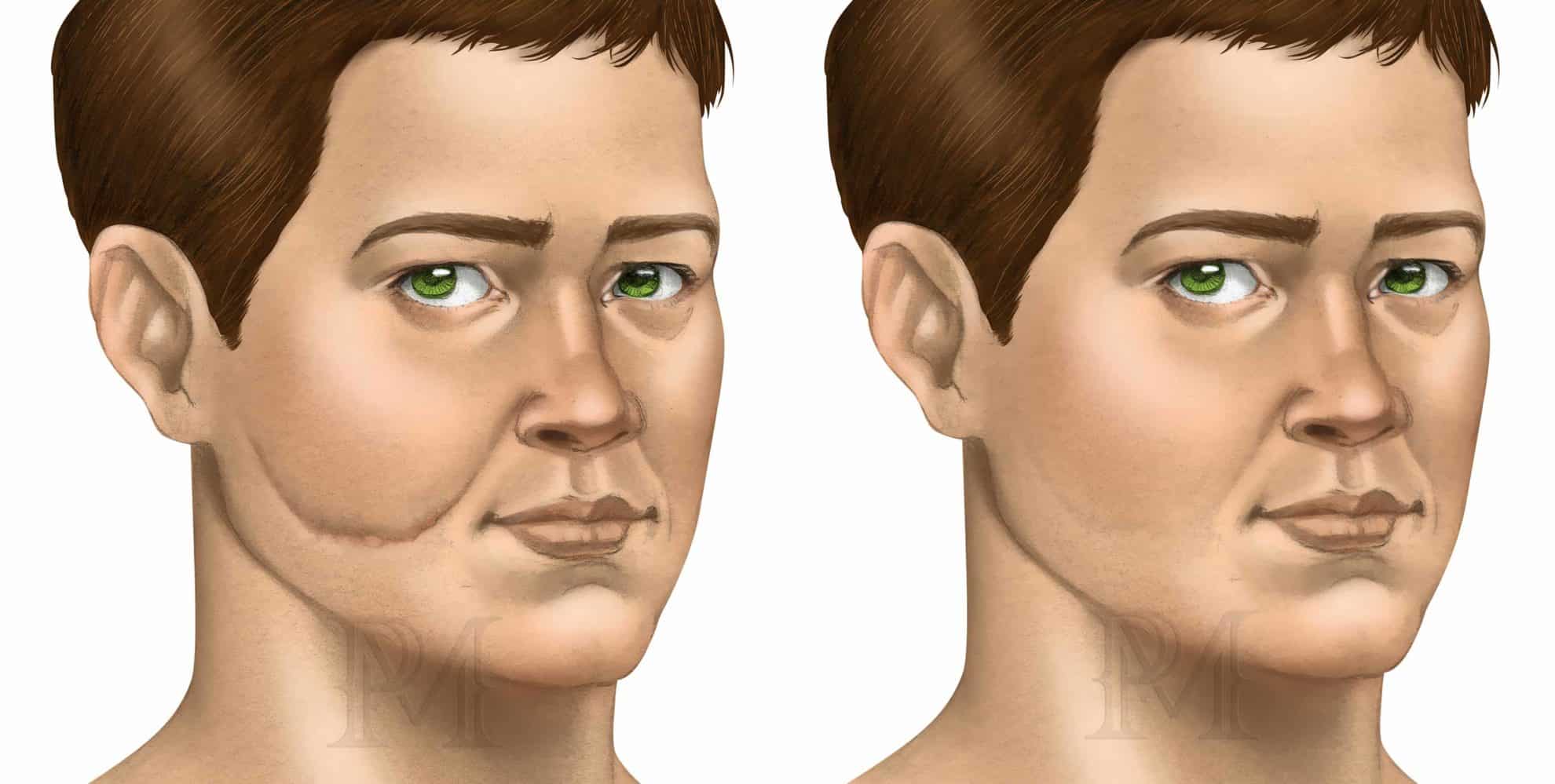 Cicatriz Reduccion De Pecho Antes Y Despues Correção de Cicatrizes - Dr. Daniel Pinheiro Machado | Cirurgião Plástico